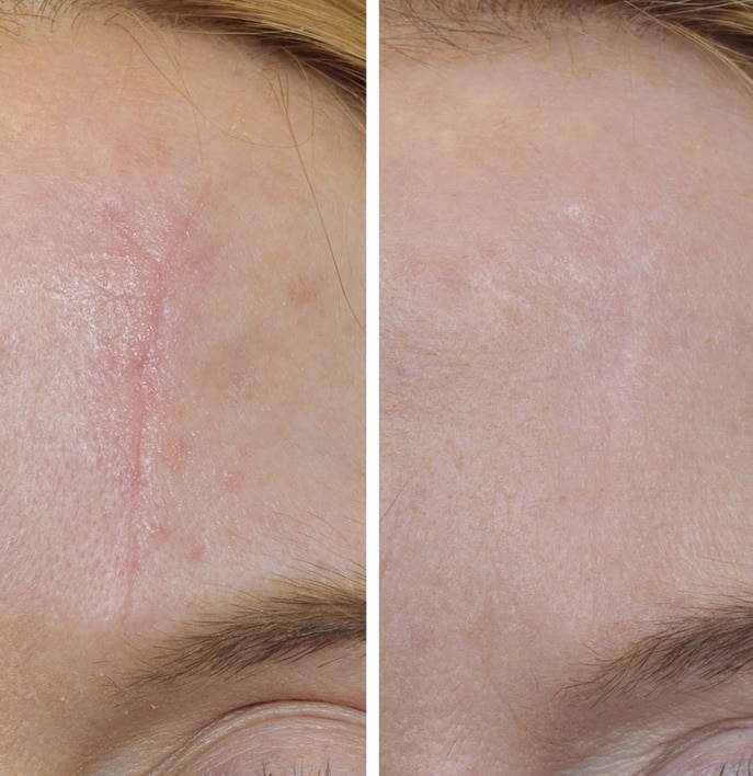 How to Improve the Appearance of Scars - Northwestern Specialists