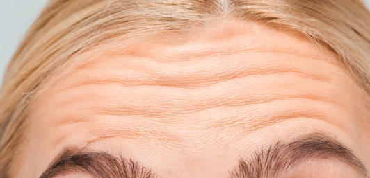 deep-forehead-wrinkles