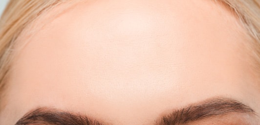 large-forehead