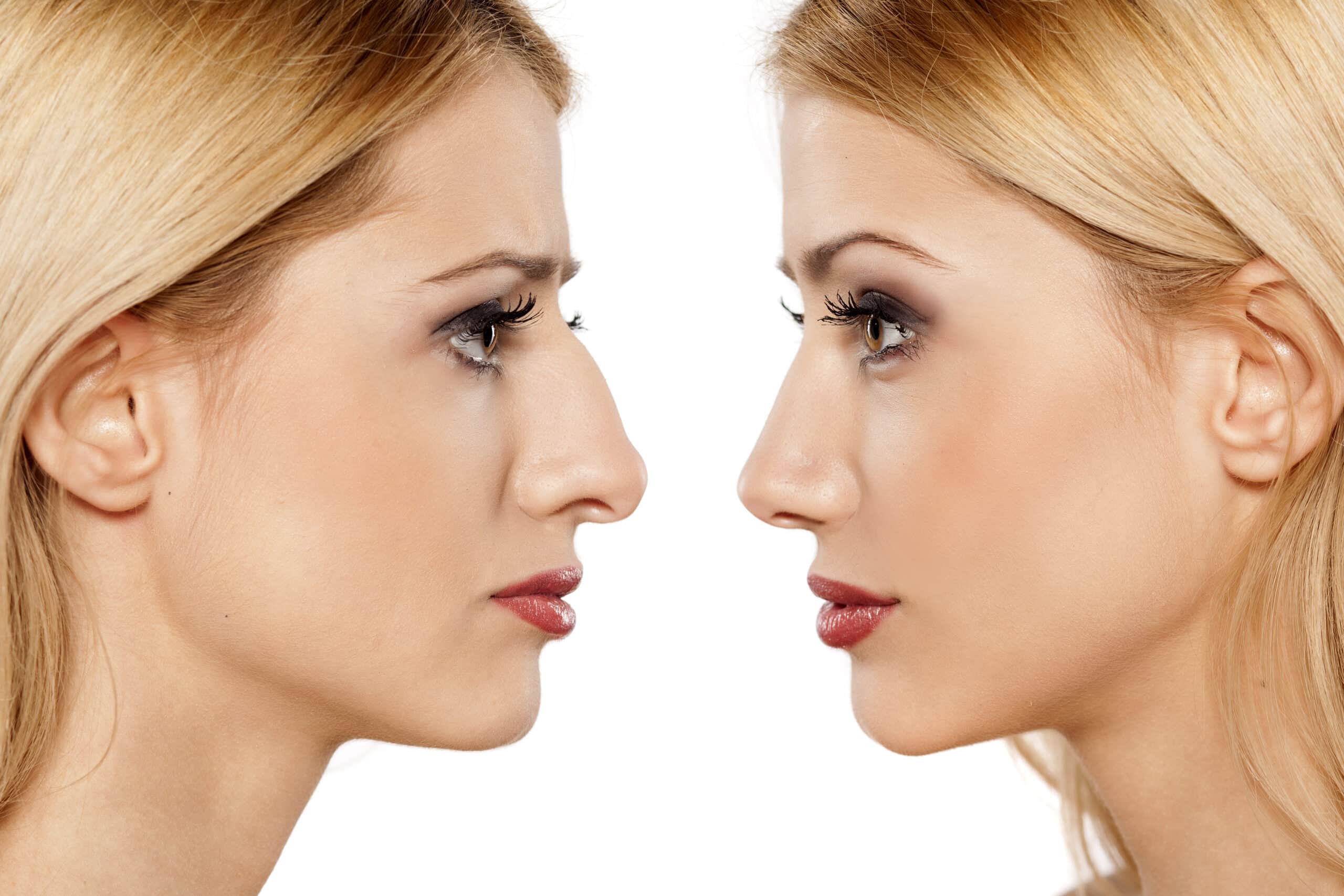Things to Avoid After a Rhinoplasty Surgery