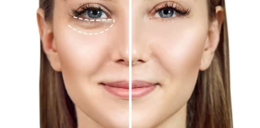 Blepharoplasty Undereye Bags