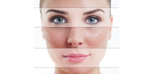Chemical Peels For Uneven Skin Tone